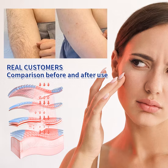 Ice Cool Высококачественное косметическое оборудование Безболезненное удаление волос IPL лазер