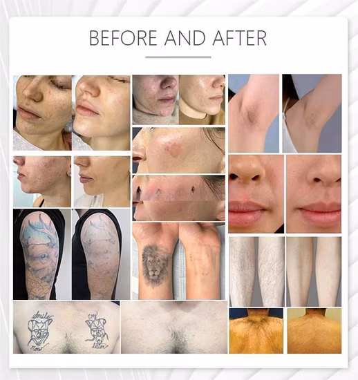 2023 M22 IPL Opt Skin Photon Rejuvenation Beauty Equipment Aopt Laser M22 Lumenis Resurfx Cool Haarentfernungsgerät